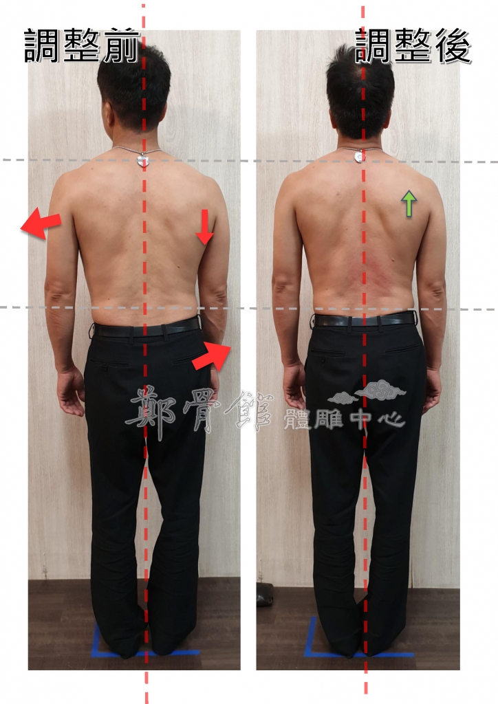 調整前後對比：駝背圓肩體態改善